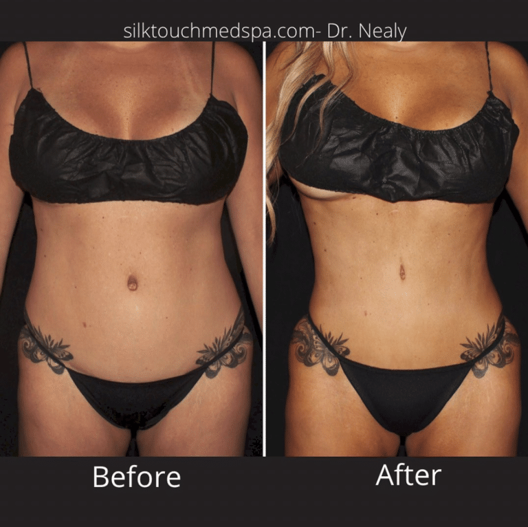 Lipo 360 / Liposuction before and after images - LIPO 360 Maryland