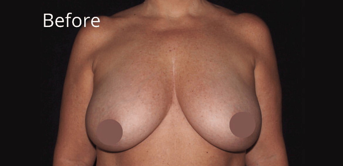 Before Image: Breast Reduction - front