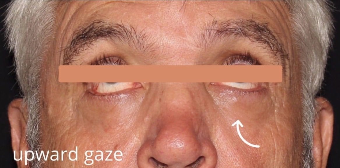 After Image: Blepharoplasty & CO2 Resurfacing - front