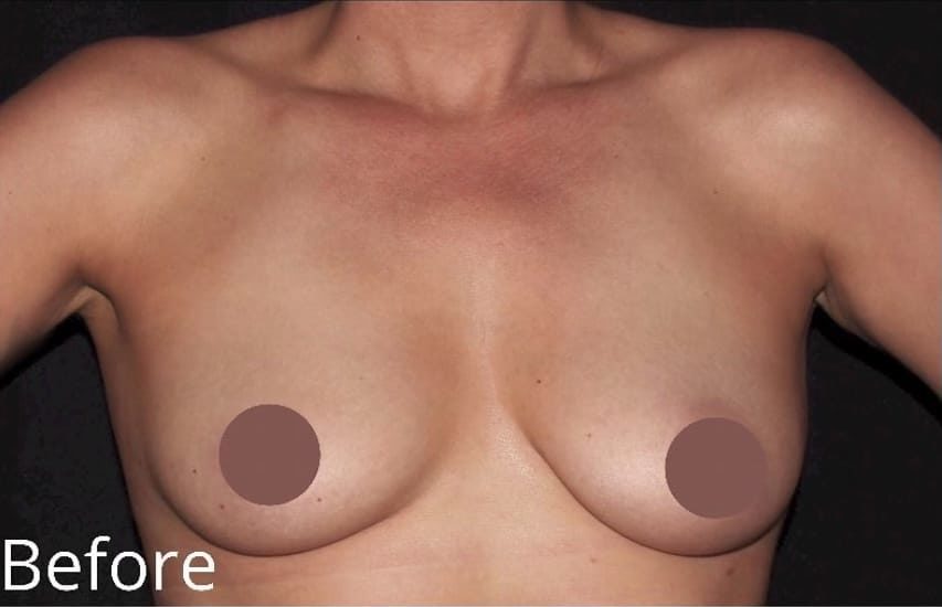 Before Image: Breast Augmentation - front