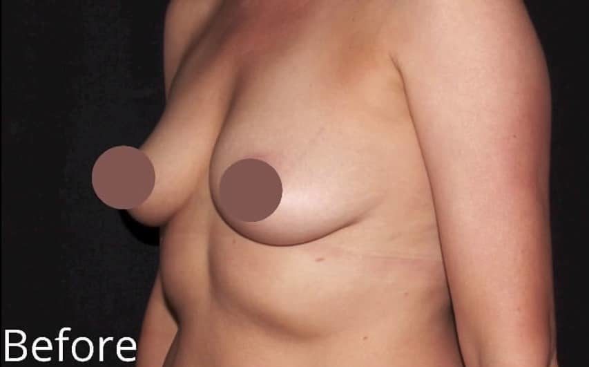 Before Image: Breast Augmentation - left-front-oblique