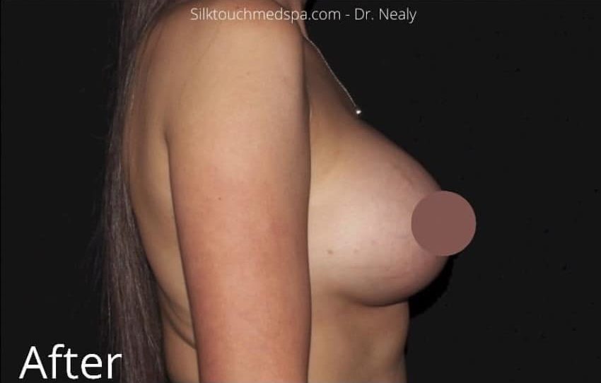 After Image: Breast Augmentation - right-side