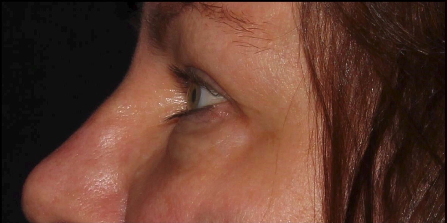 Before Image: Blepharoplasty & CO2 Resurfacing - left-side