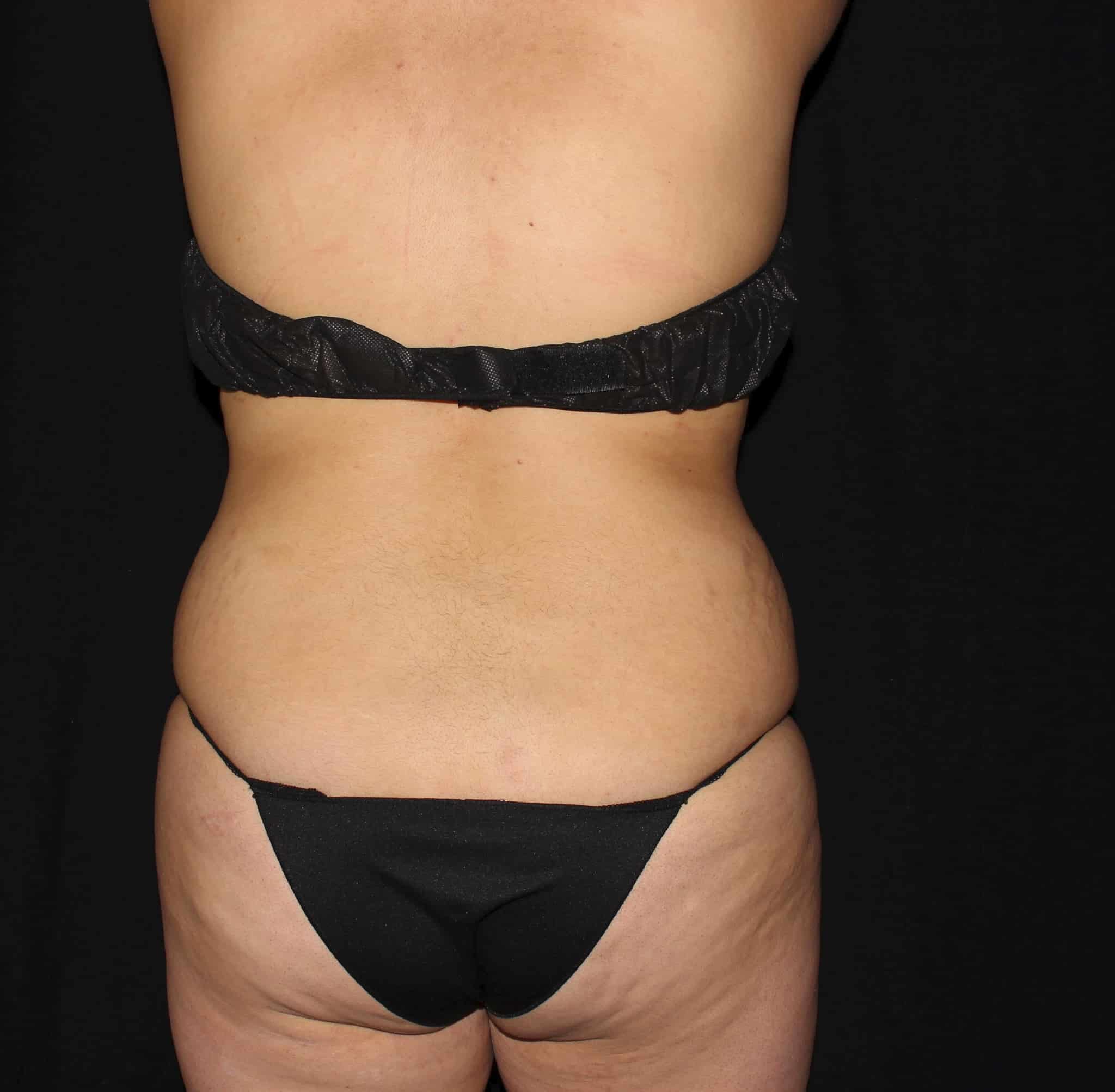 Before Image: Abdomen & Waist - back