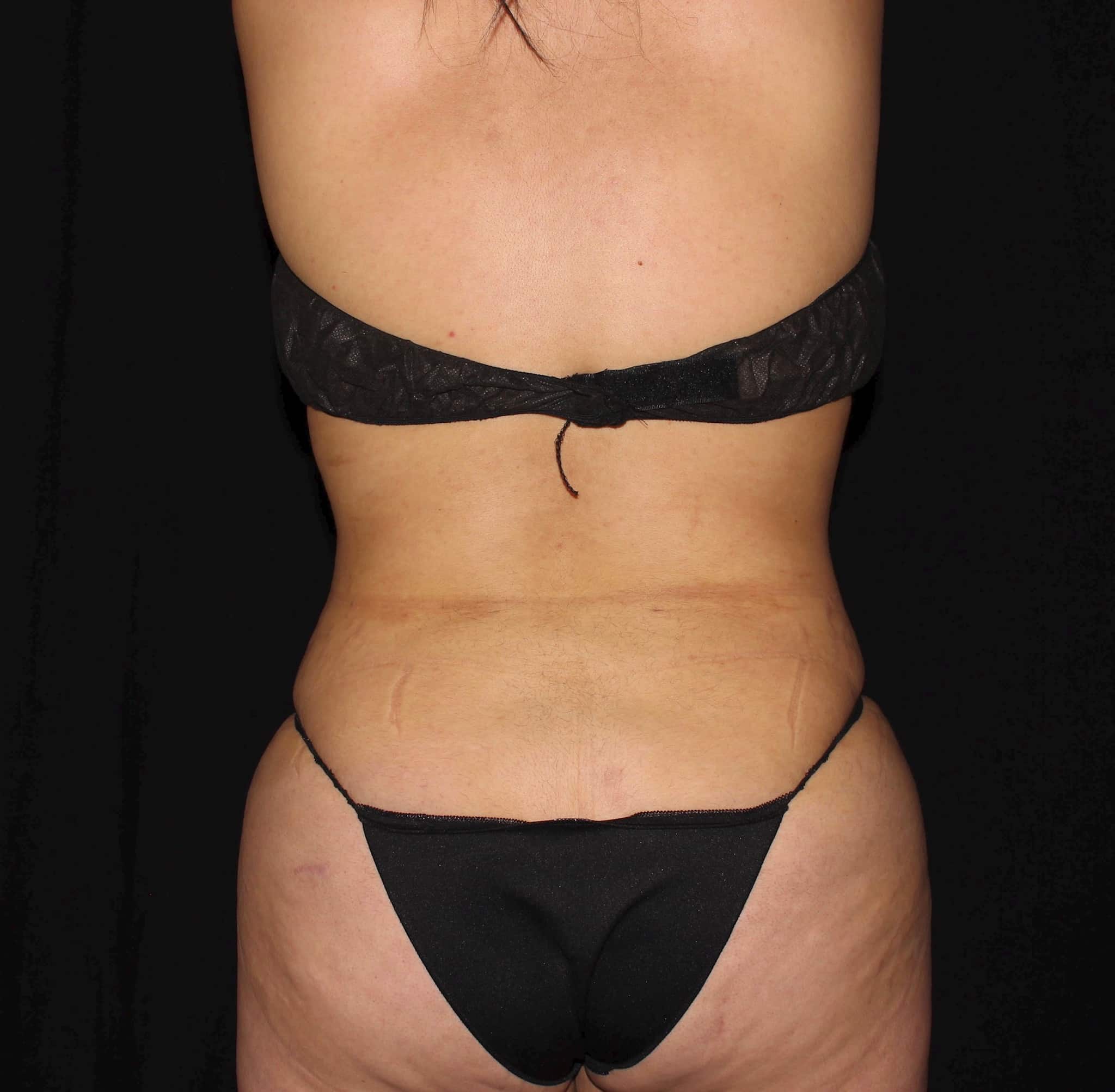 After Image: Abdomen & Waist - back