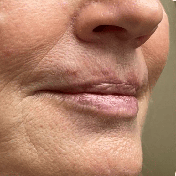 Before Image: Lip Filler - 