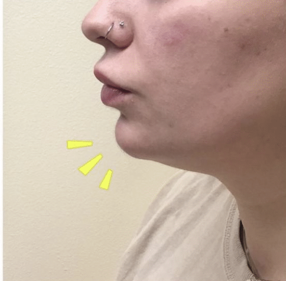 After Image: Chin Filler - left-side