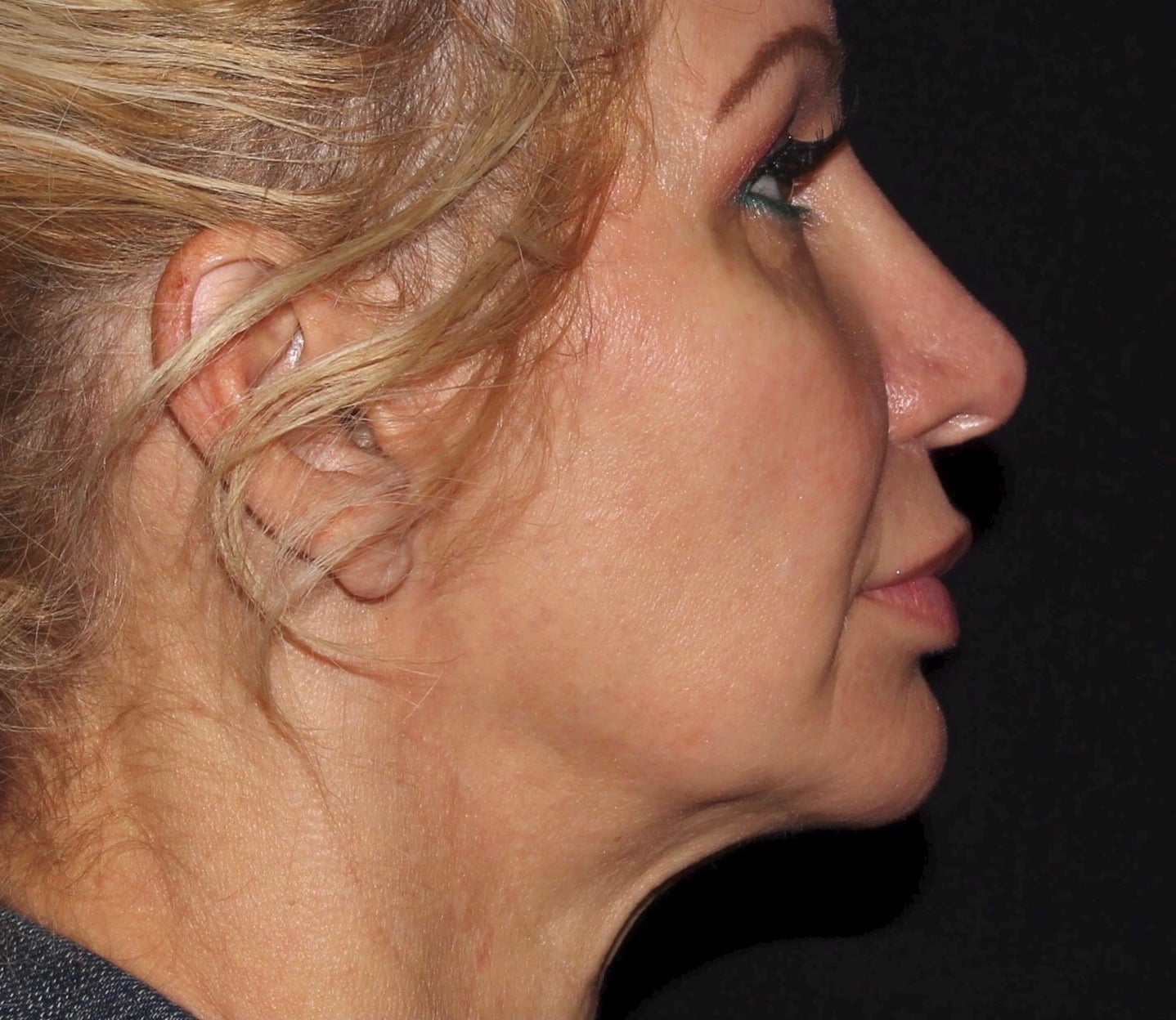 Before Image: Jawline Filler - right-side