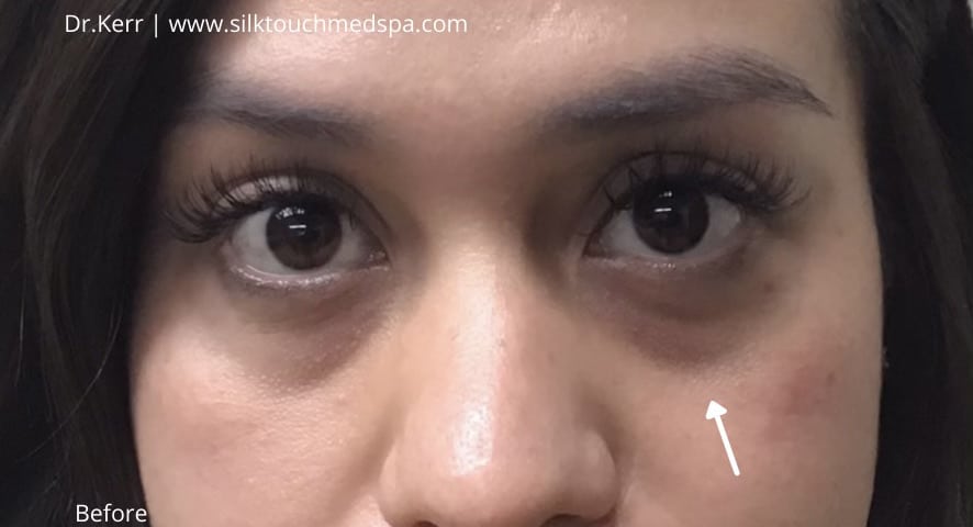 Before Image: Undereye Filler - front