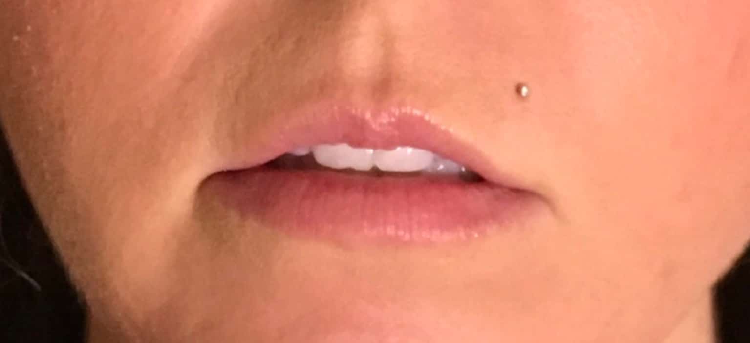 Before Image: Lip Filler - front