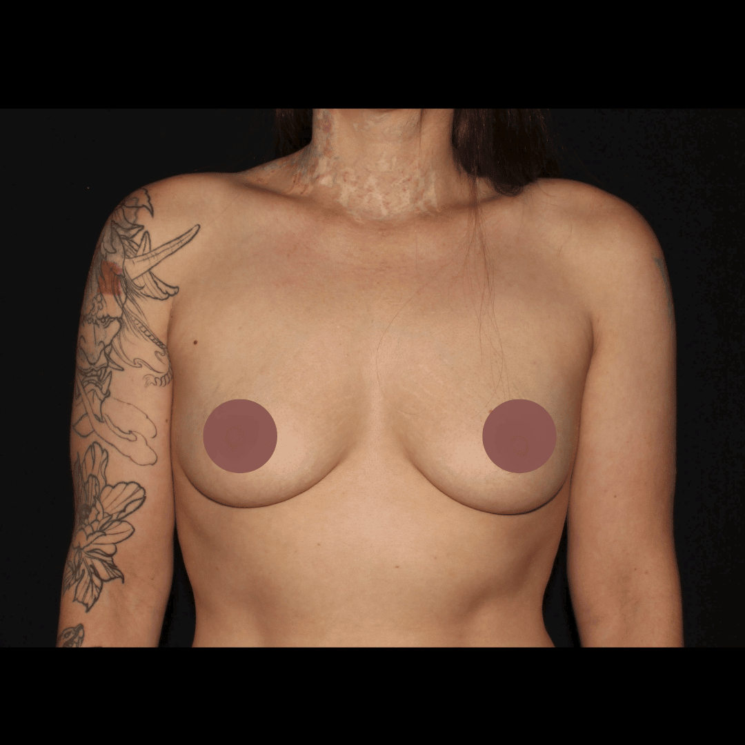 Before Image: Breast Augmentation - front