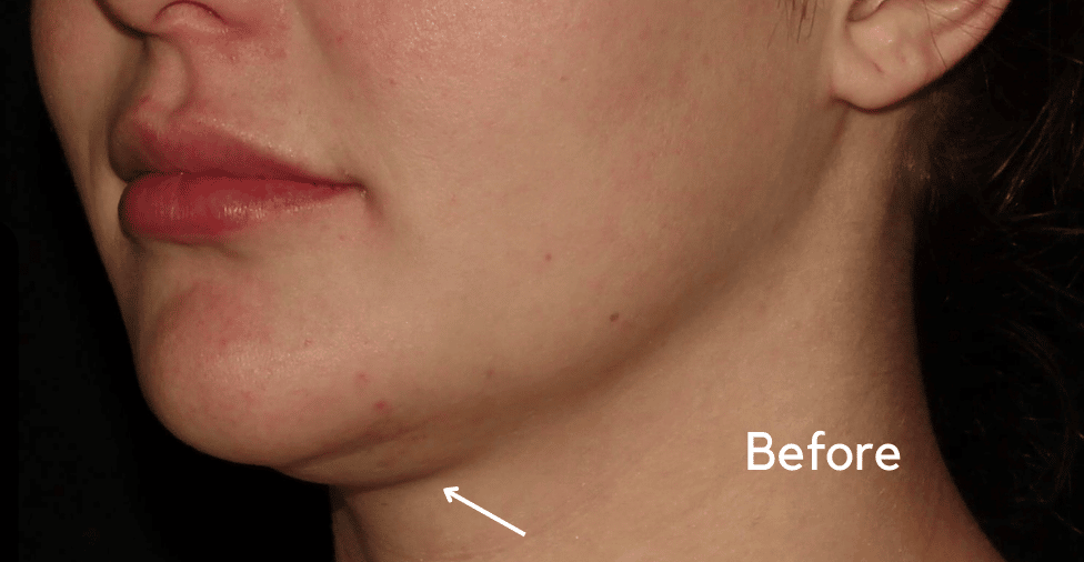 Before Image: Neck - left-front-oblique