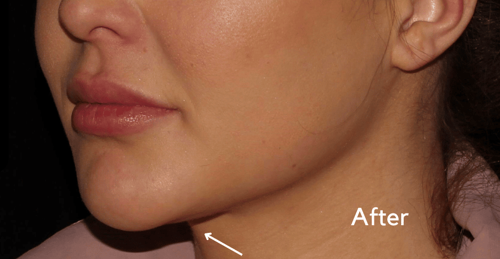 After Image: Neck - left-front-oblique