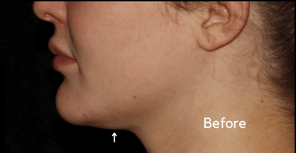 Before Image: Neck - left-side