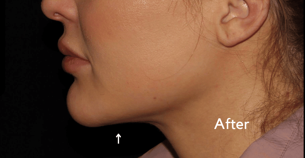 After Image: Neck - left-side