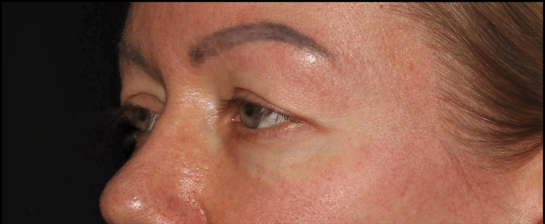 Before Image: Blepharoplasty & CO2 Resurfacing - left-front-oblique