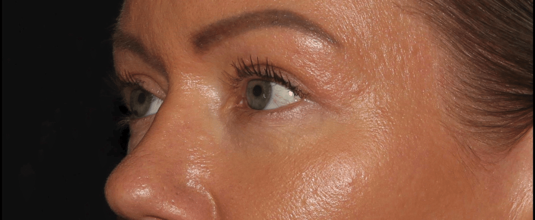 After Image: Blepharoplasty & CO2 Resurfacing - left-front-oblique