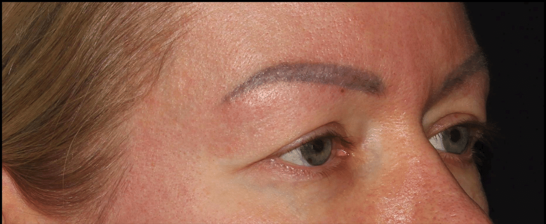 Before Image: Blepharoplasty & CO2 Resurfacing - right-front-oblique