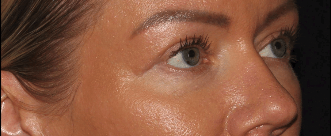 After Image: Blepharoplasty & CO2 Resurfacing - right-front-oblique