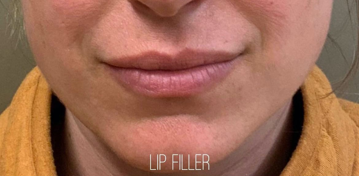 Before Image: Lip Filler - front