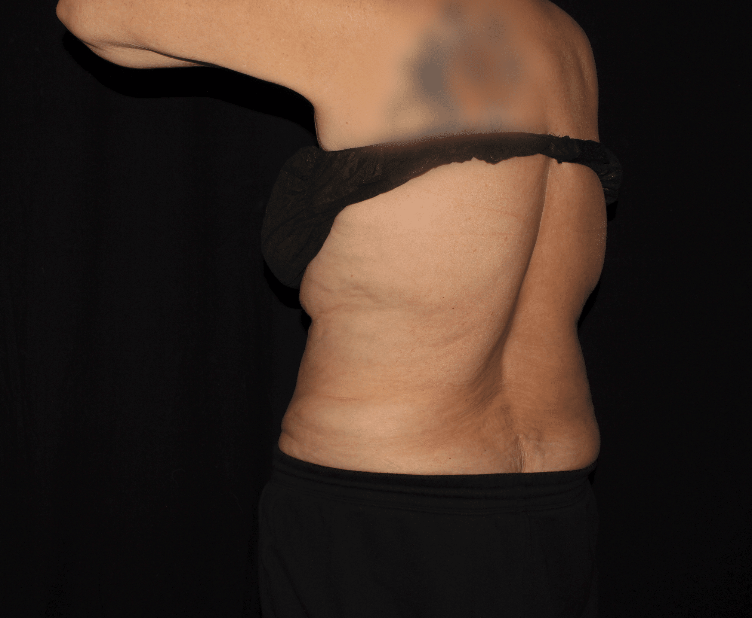 Before Image: Bilateral Bra Fat - left-back-oblique