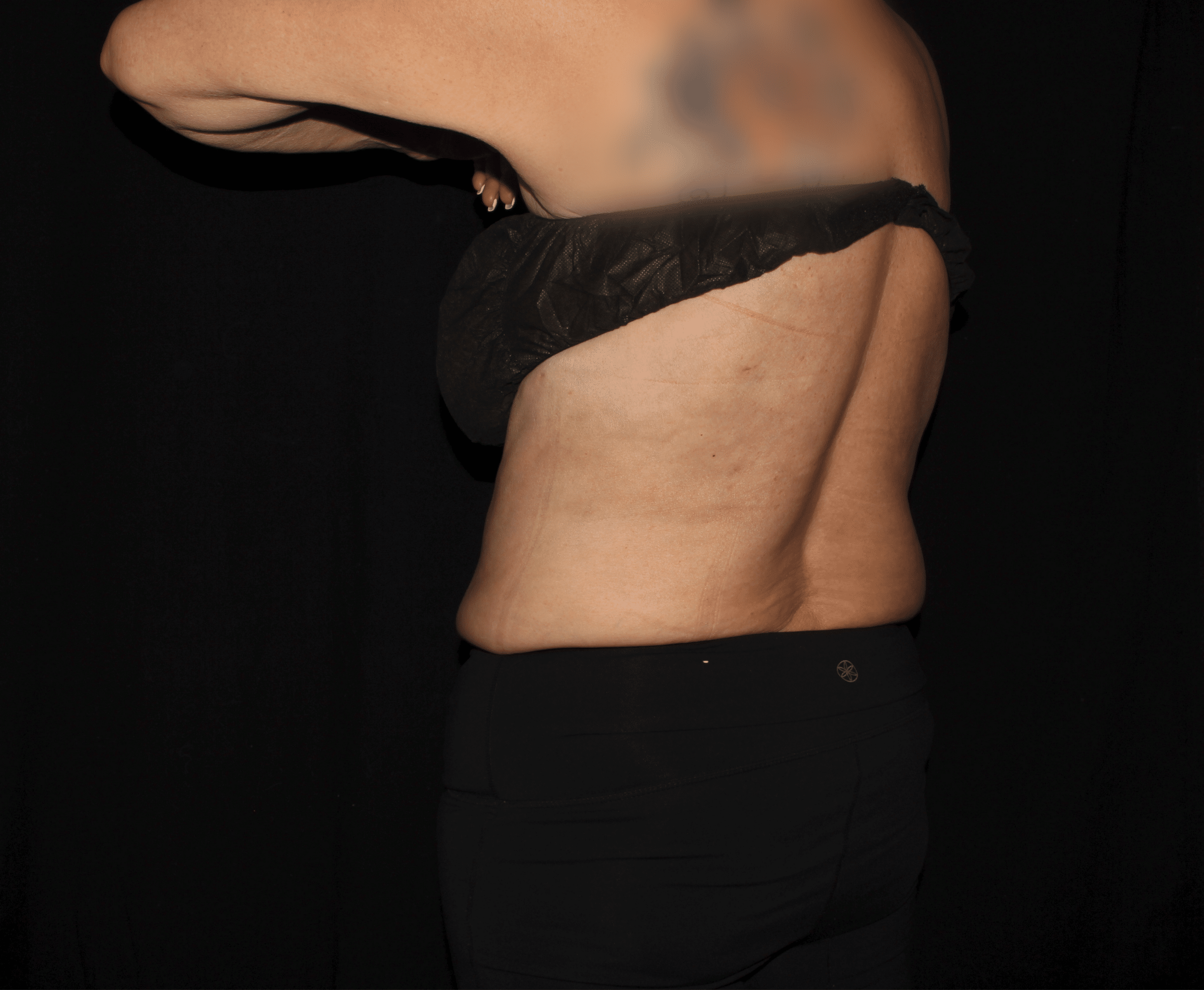 After Image: Bilateral Bra Fat - left-back-oblique