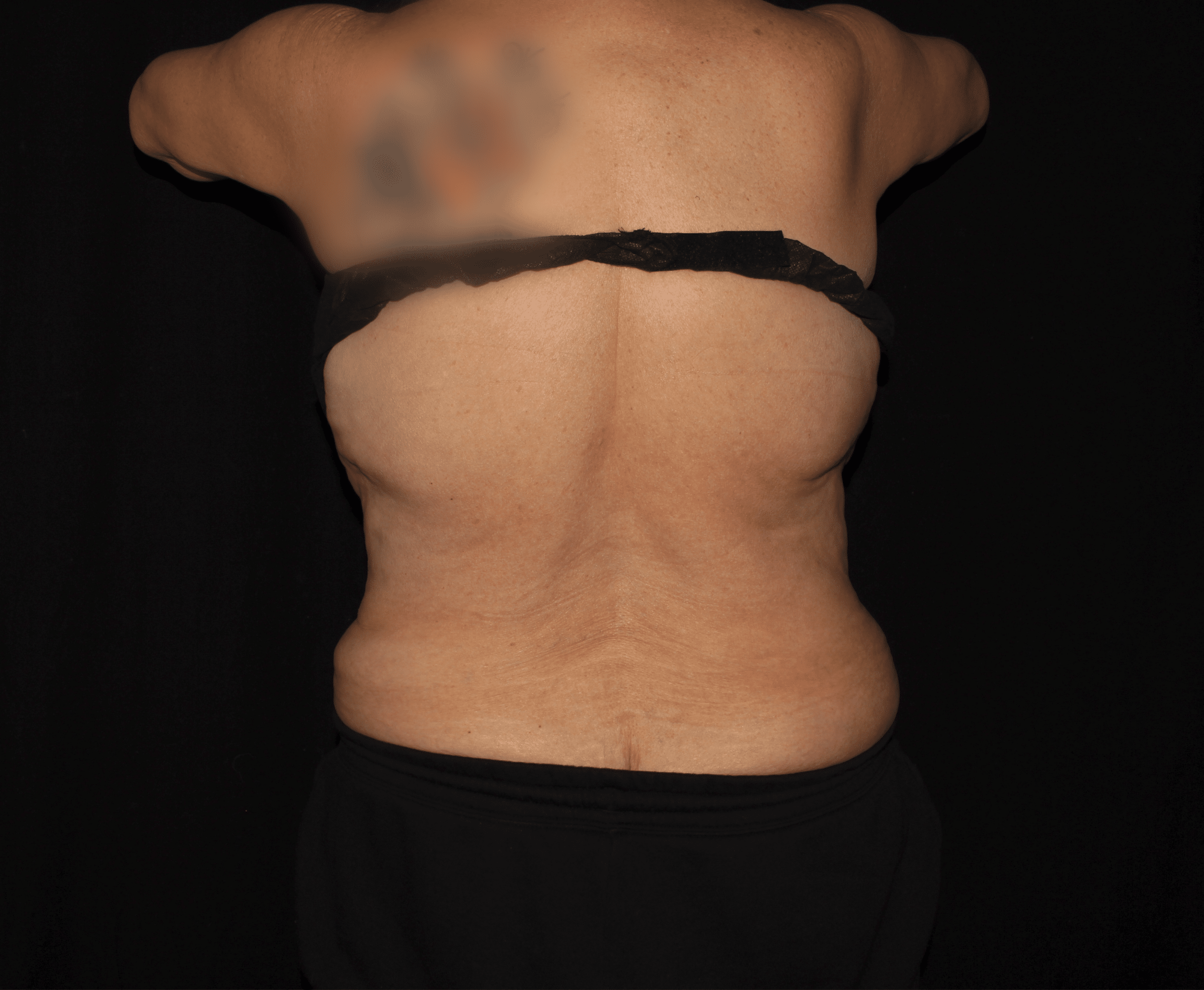 Before Image: Bilateral Bra Fat - back