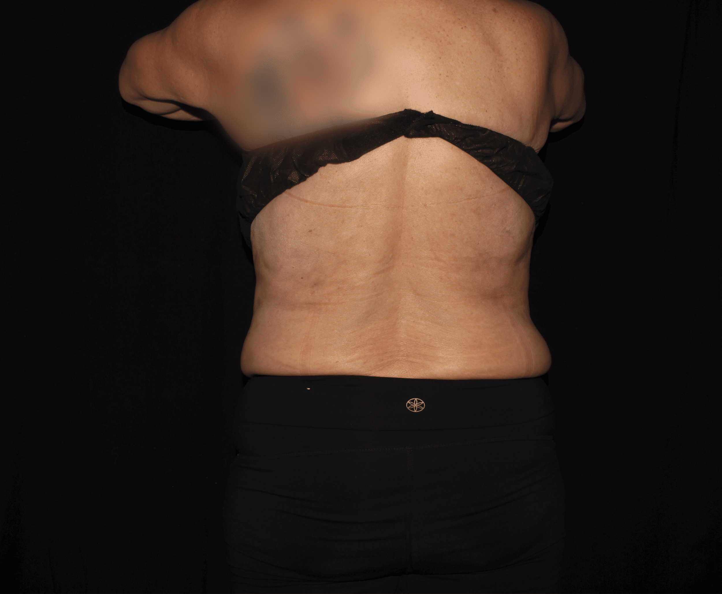 After Image: Bilateral Bra Fat - back