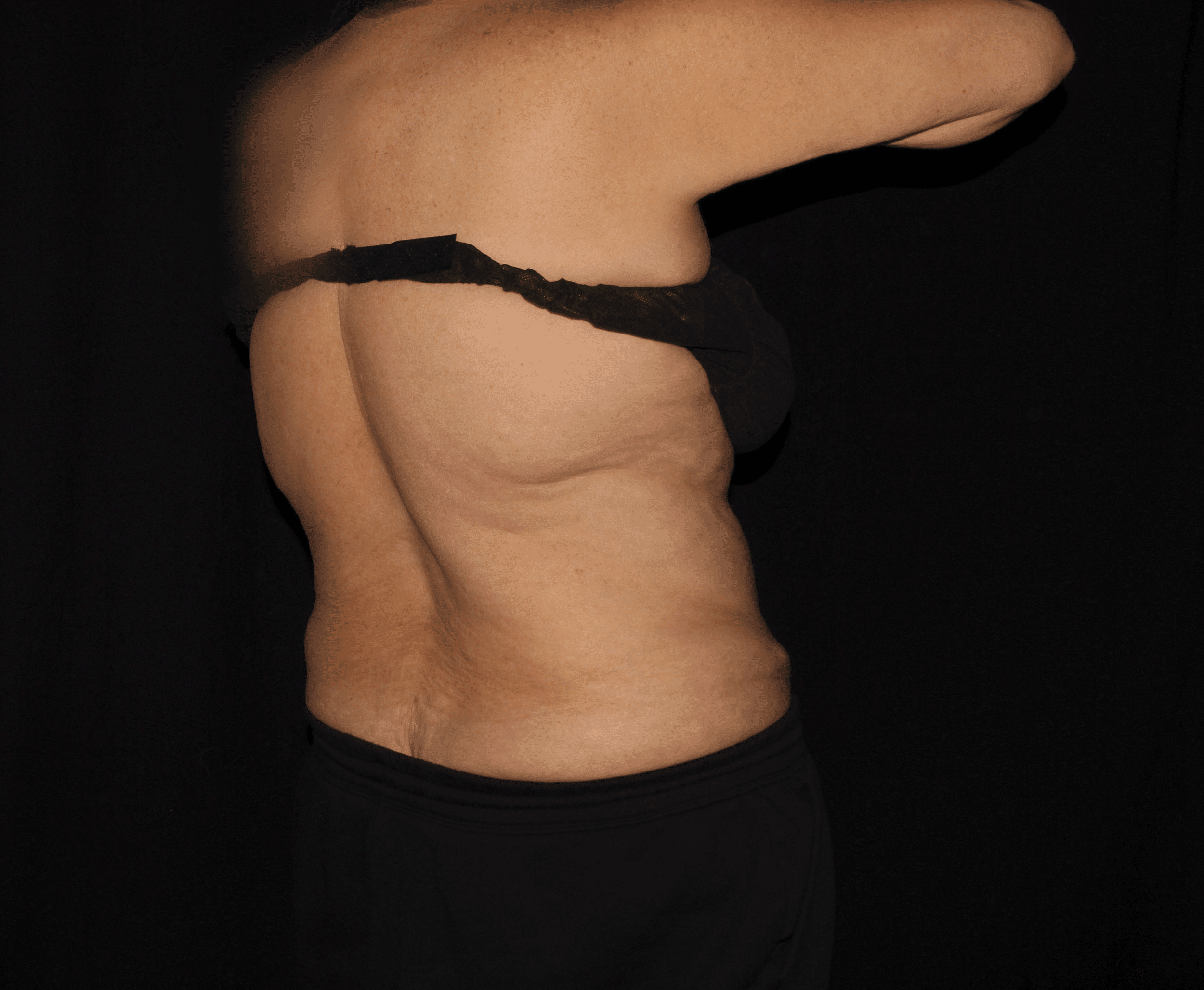 Before Image: Bilateral Bra Fat - right-back-oblique