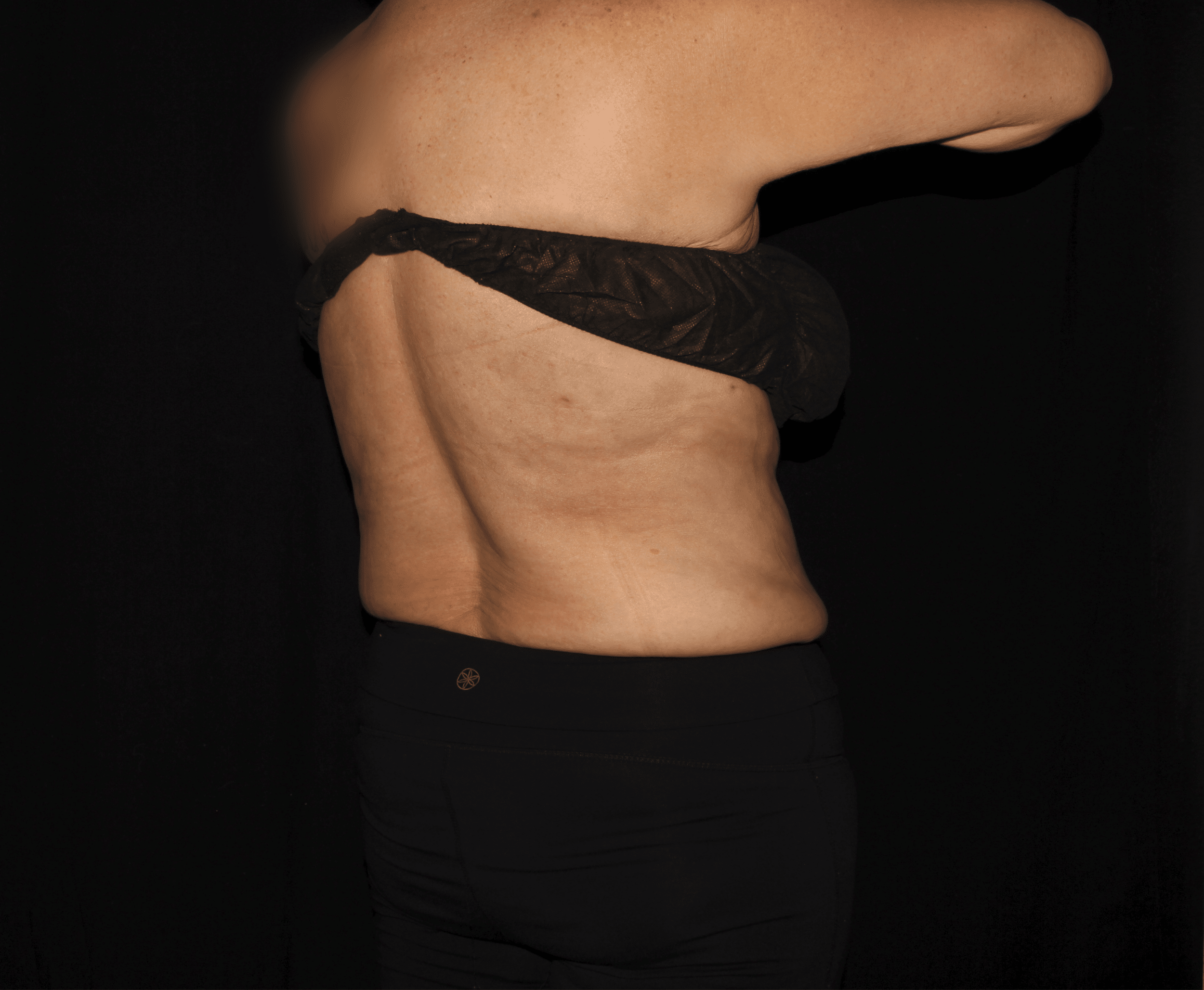 After Image: Bilateral Bra Fat - right-back-oblique