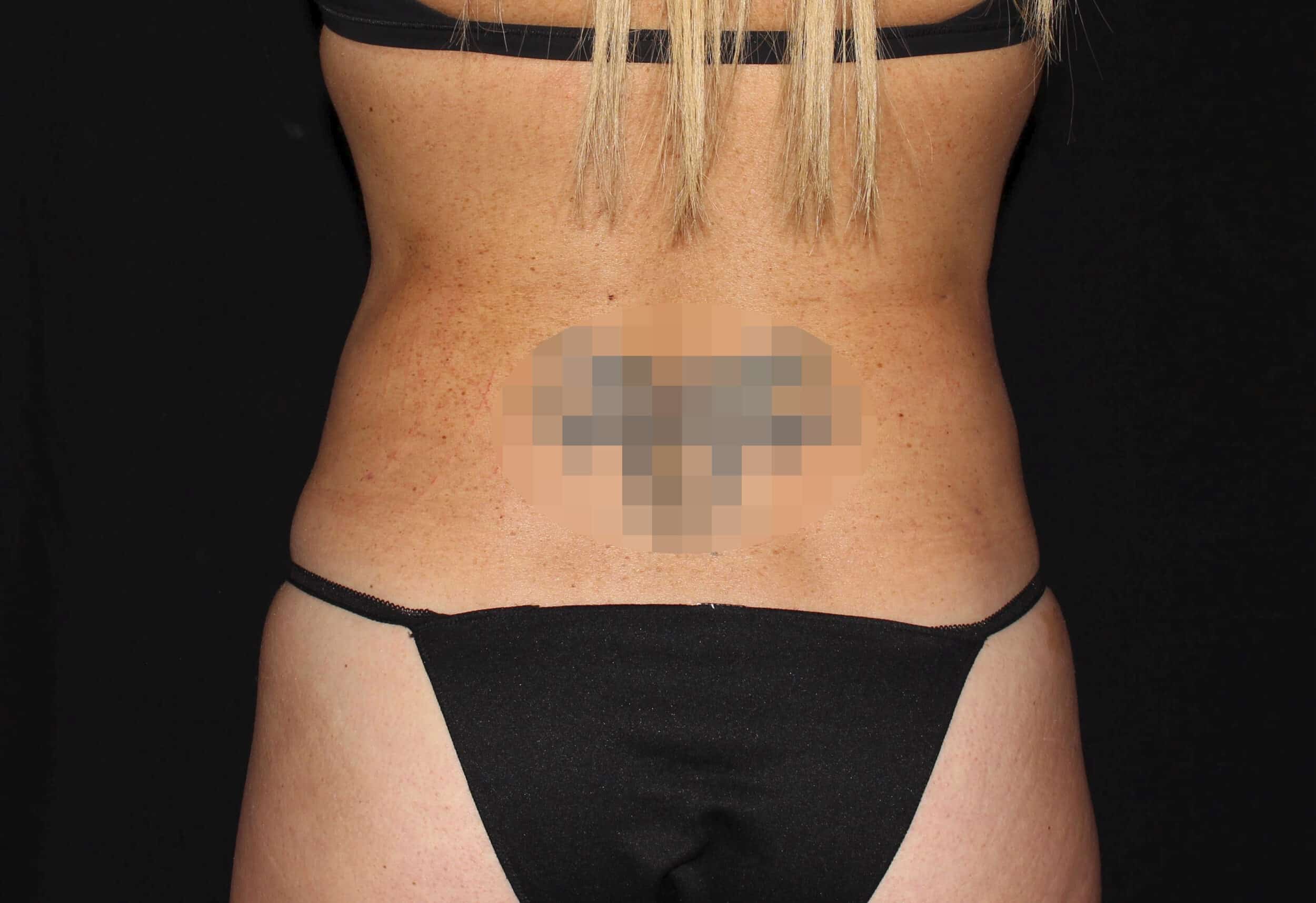 After Image: Abdomen & Waist - back