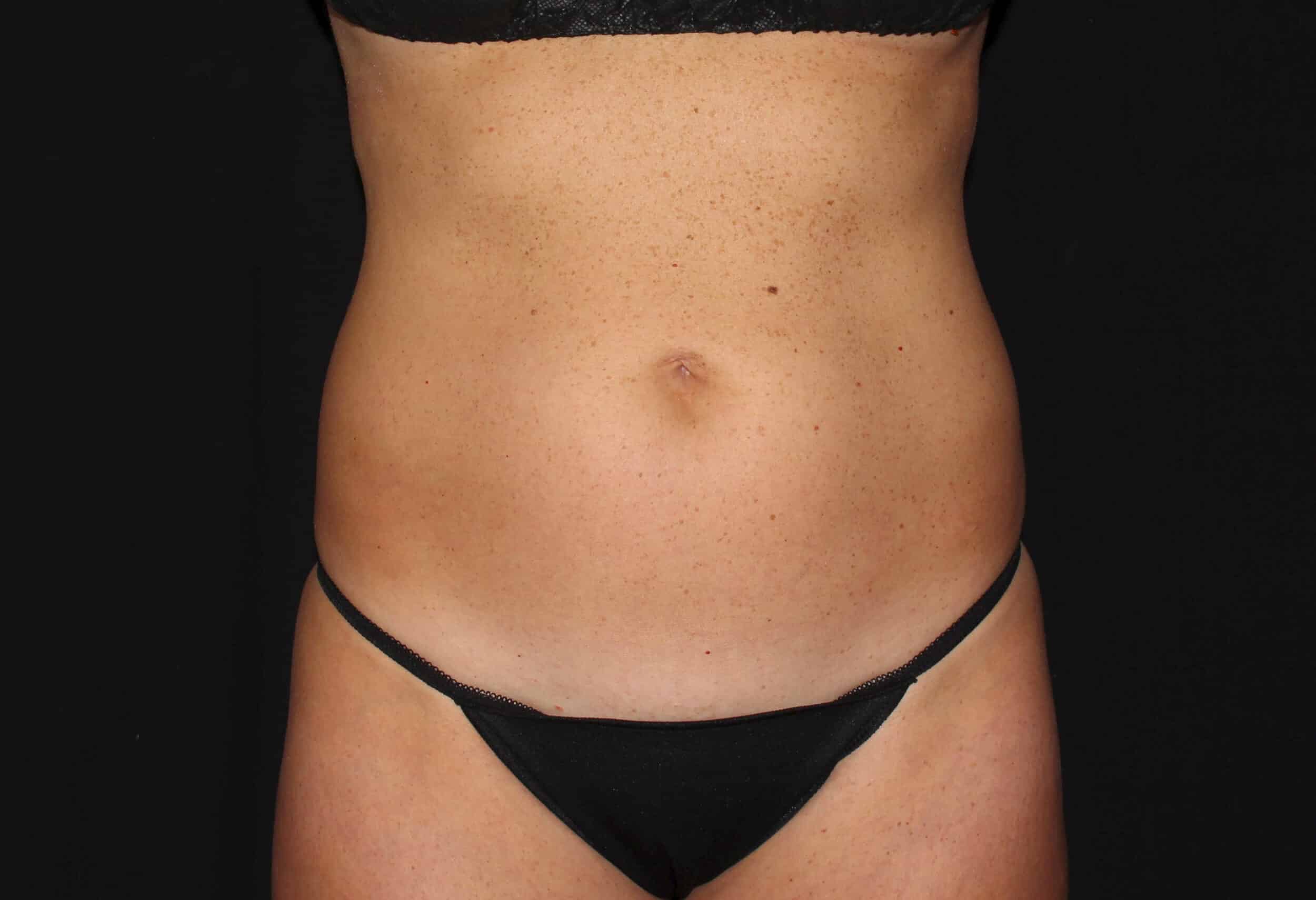 Before Image: Abdomen & Waist - front