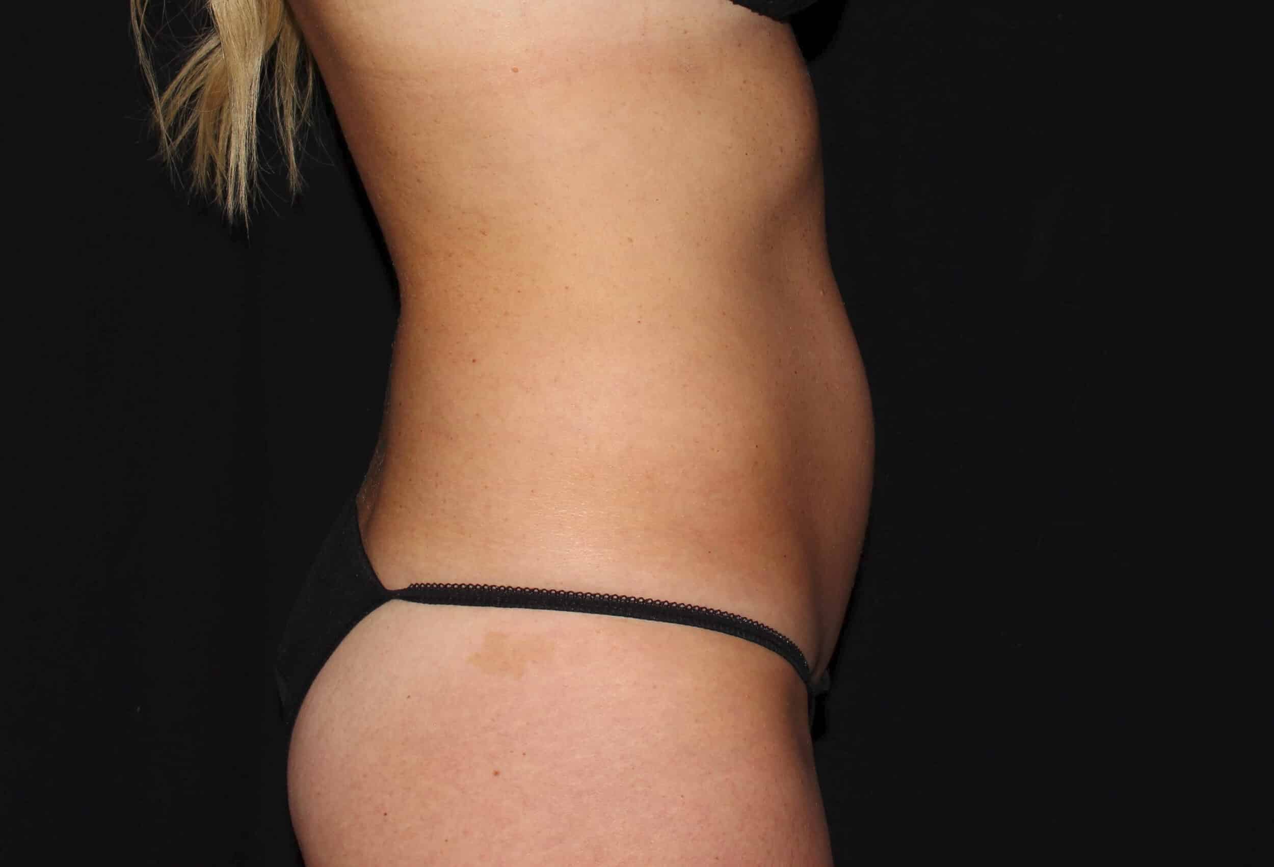 Before Image: Abdomen & Waist - right-side