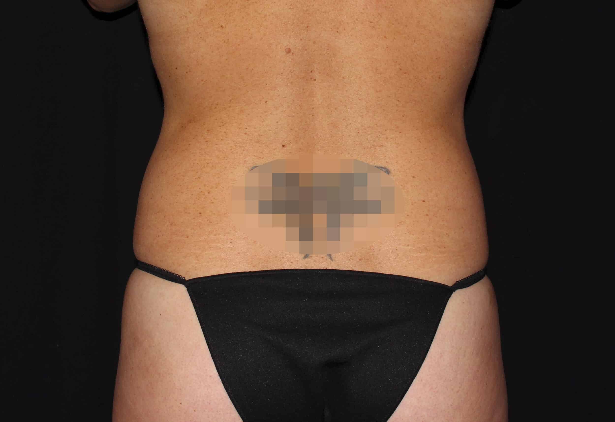 Before Image: Abdomen & Waist - back