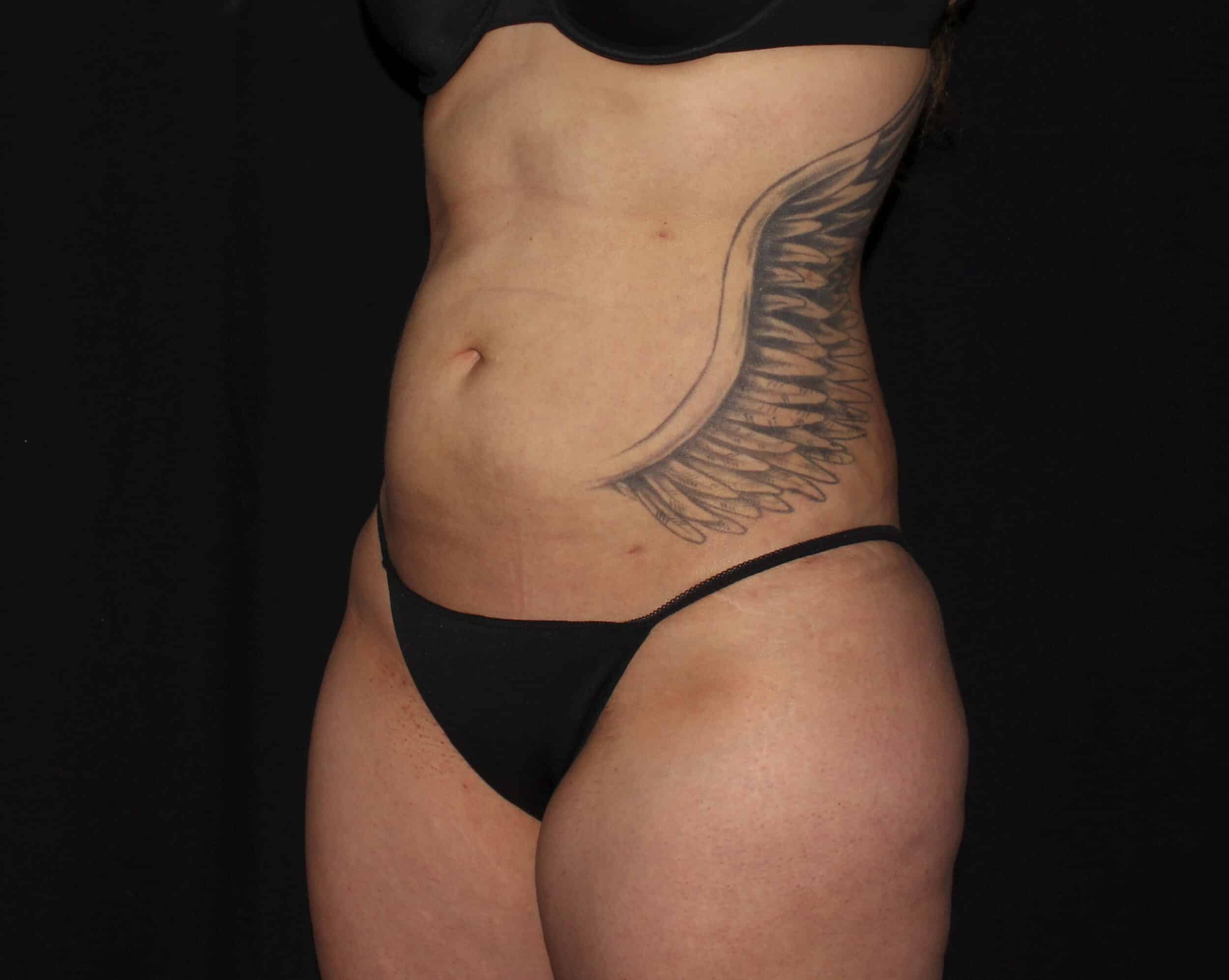 After Image: Abdomen & Waist - left-front-oblique