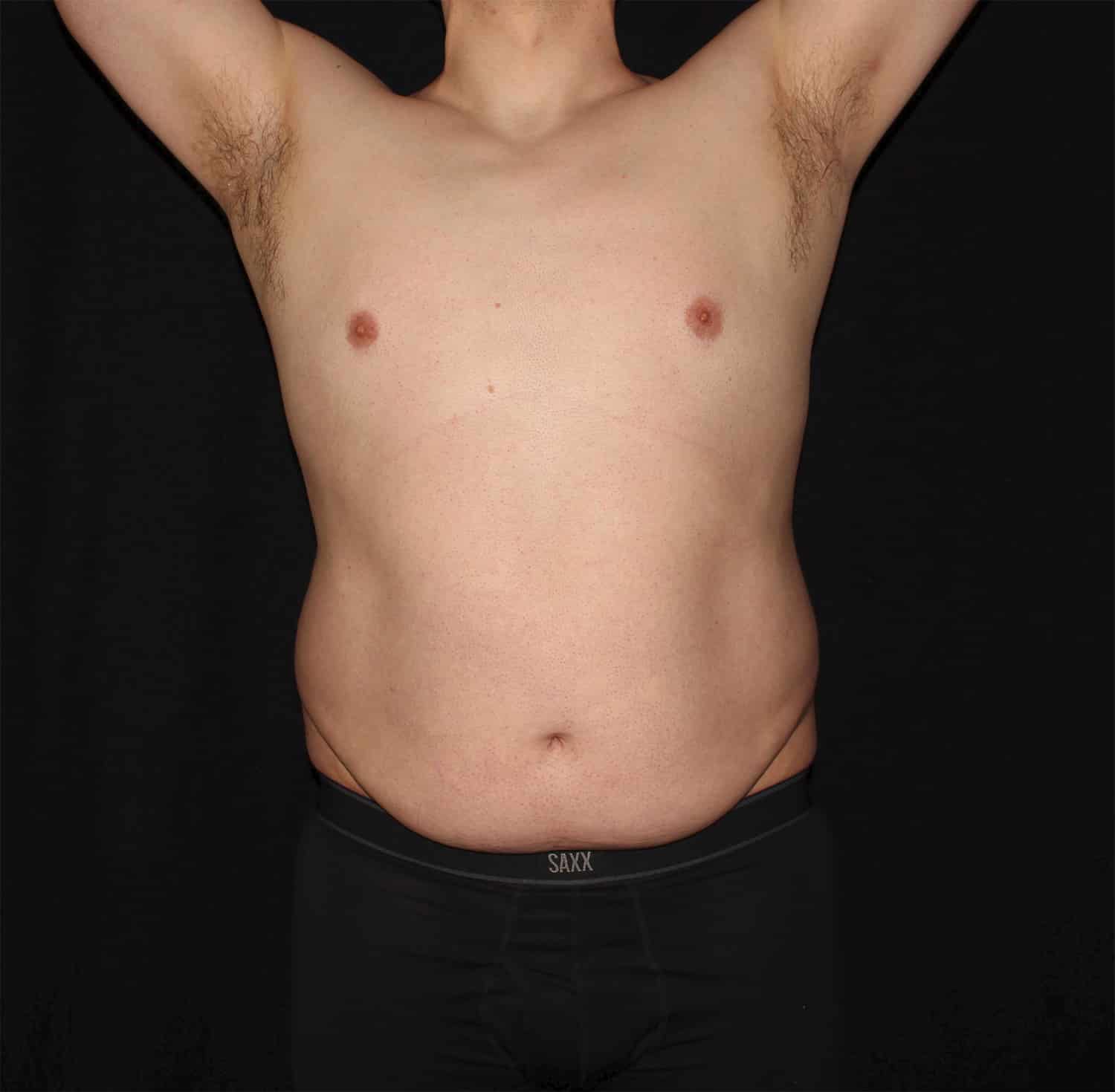 Before Image: Abdomen - front