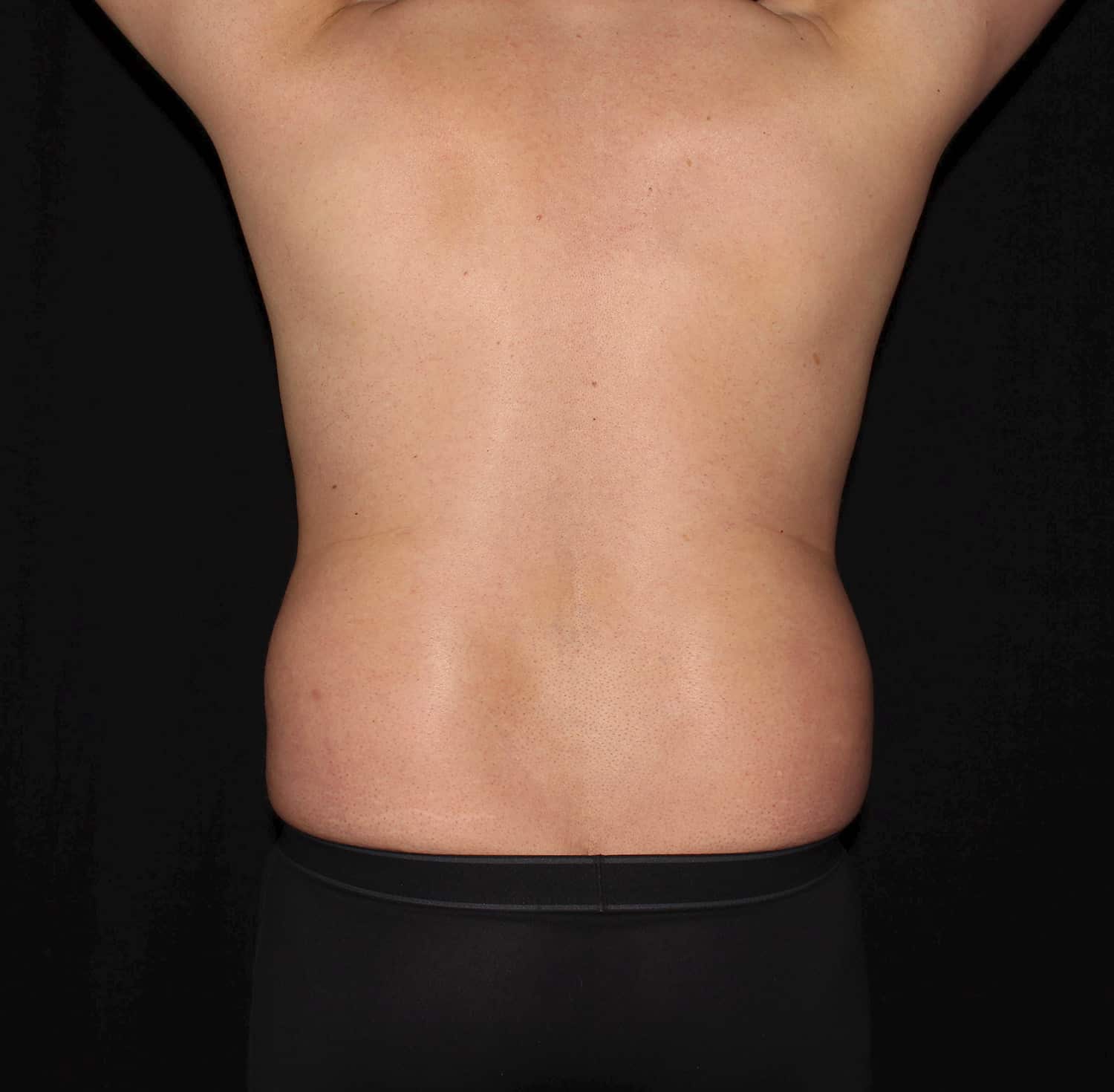 Before Image: Abdomen - back