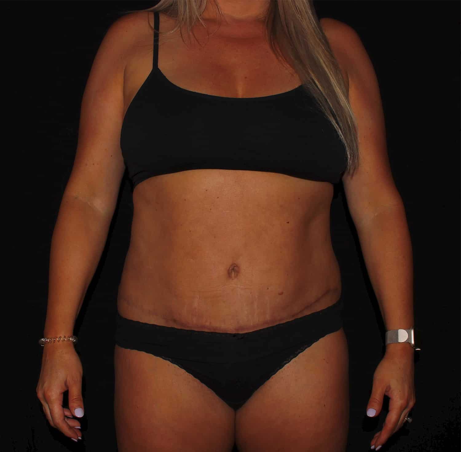 After Image: Tummy Tuck - front