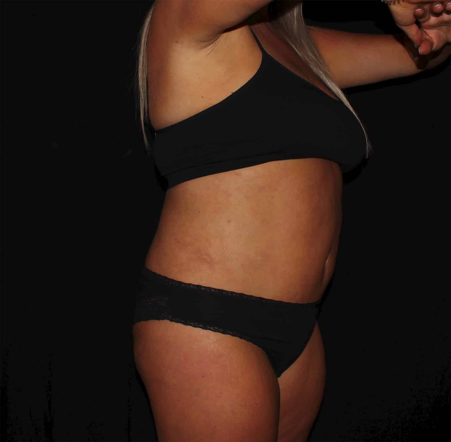 After Image: Tummy Tuck - right-front-oblique