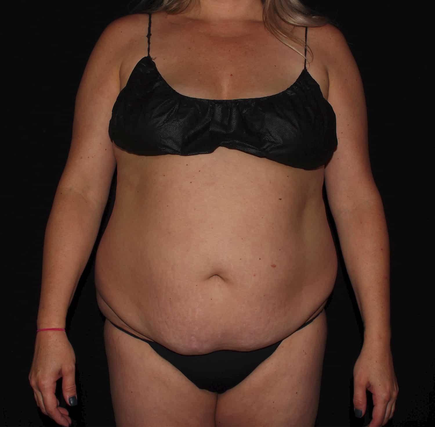 Before Image: Tummy Tuck - front