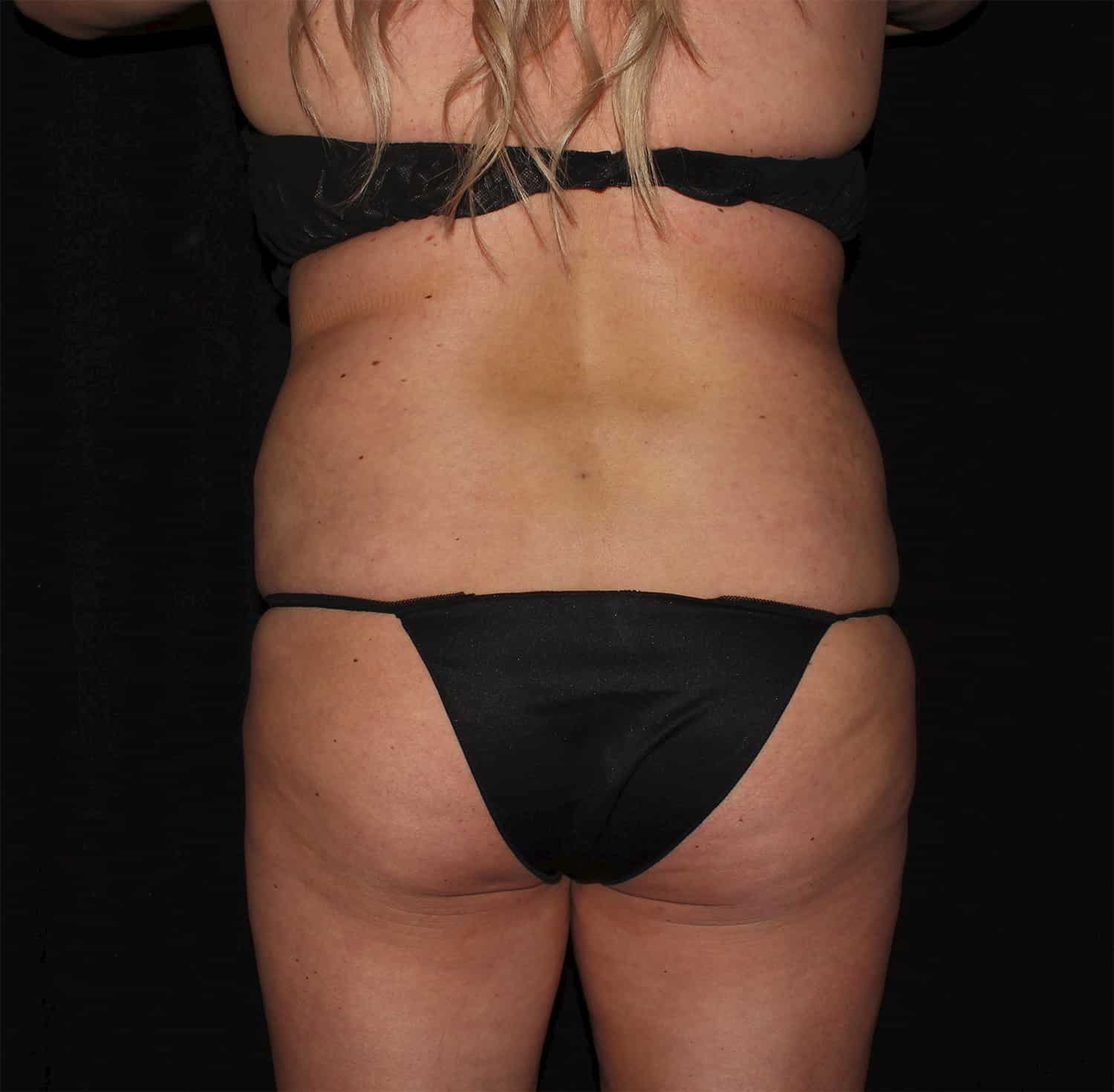 Before Image: Tummy Tuck - back