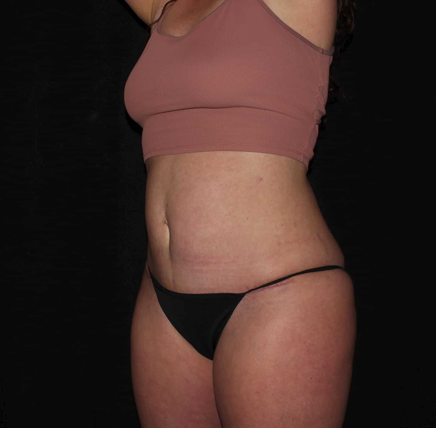 After Image: Tummy Tuck - left-front-oblique