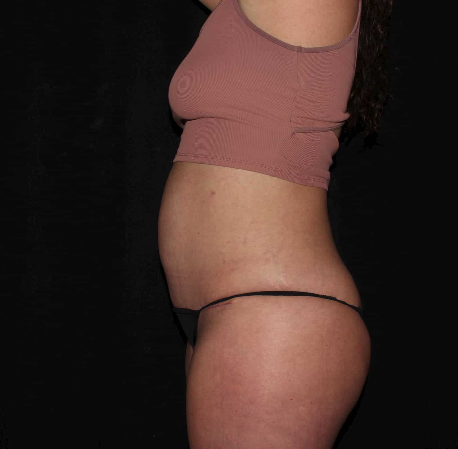 After Image: Tummy Tuck - left-side