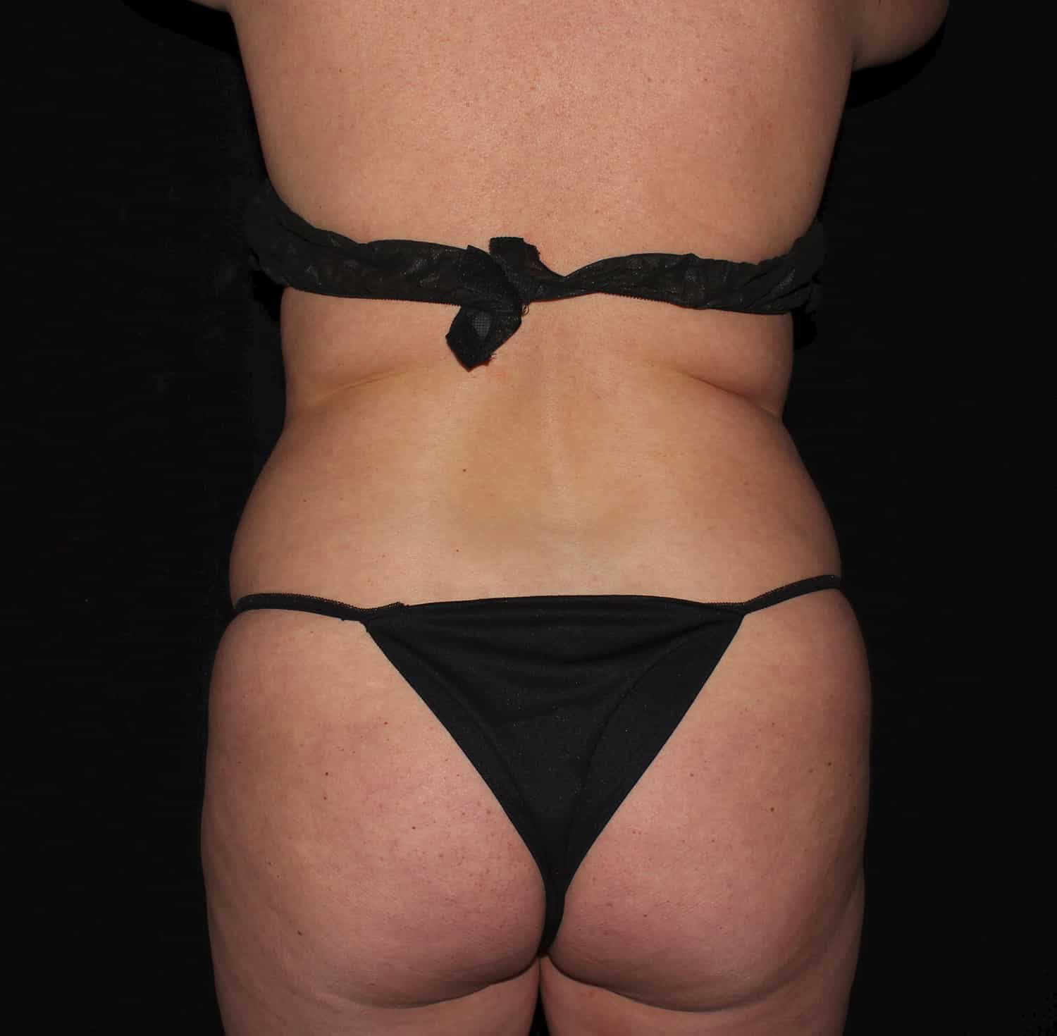 Before Image: Tummy Tuck - back