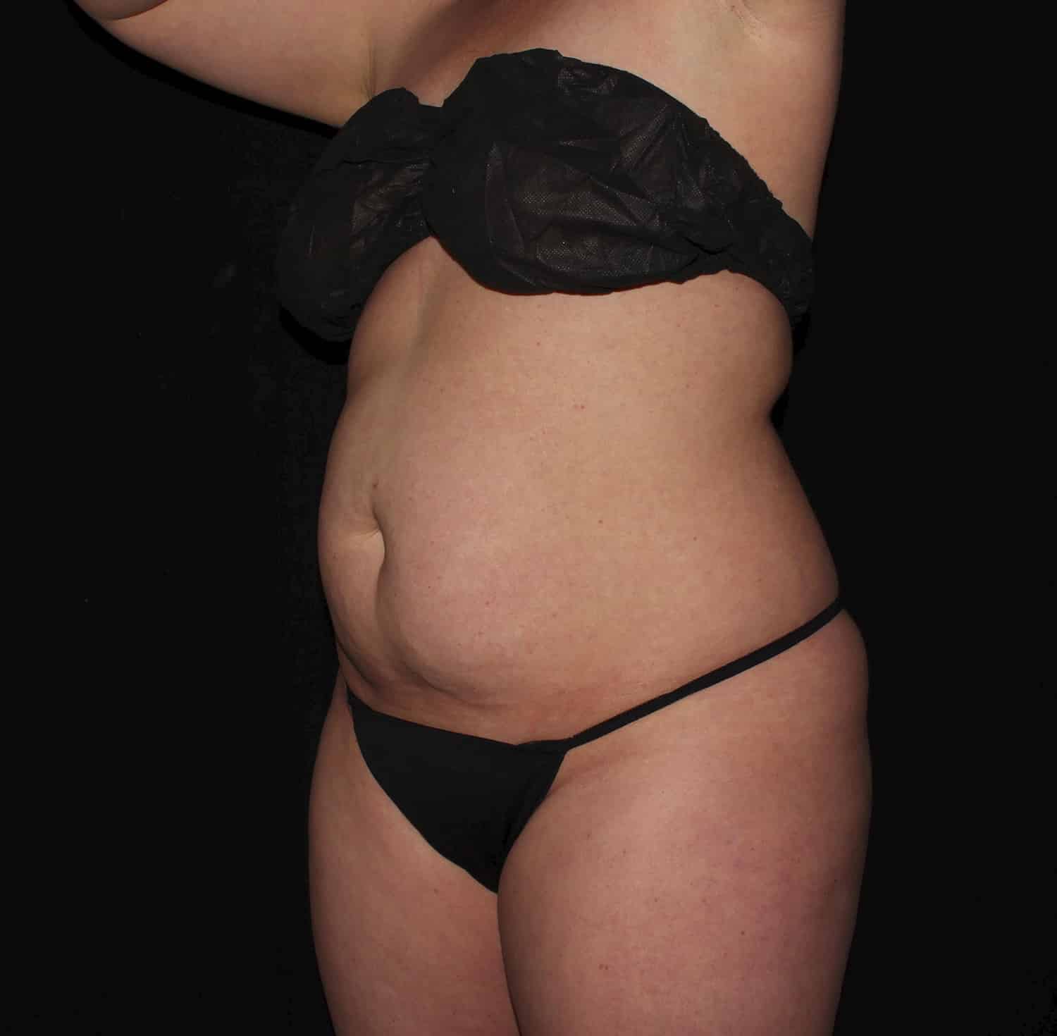 Before Image: Tummy Tuck - left-front-oblique