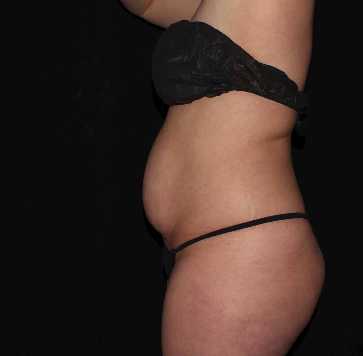 Before Image: Tummy Tuck - left-side