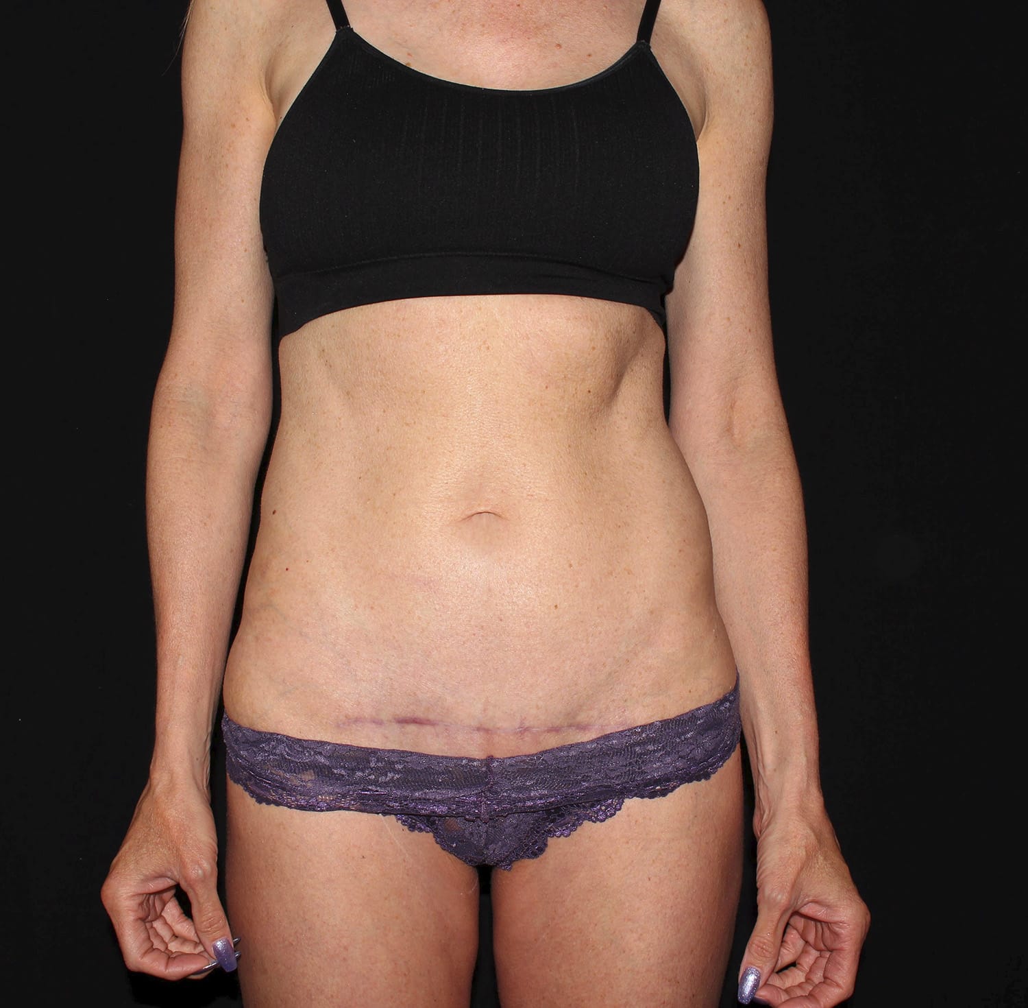 After Image: Tummy Tuck - front