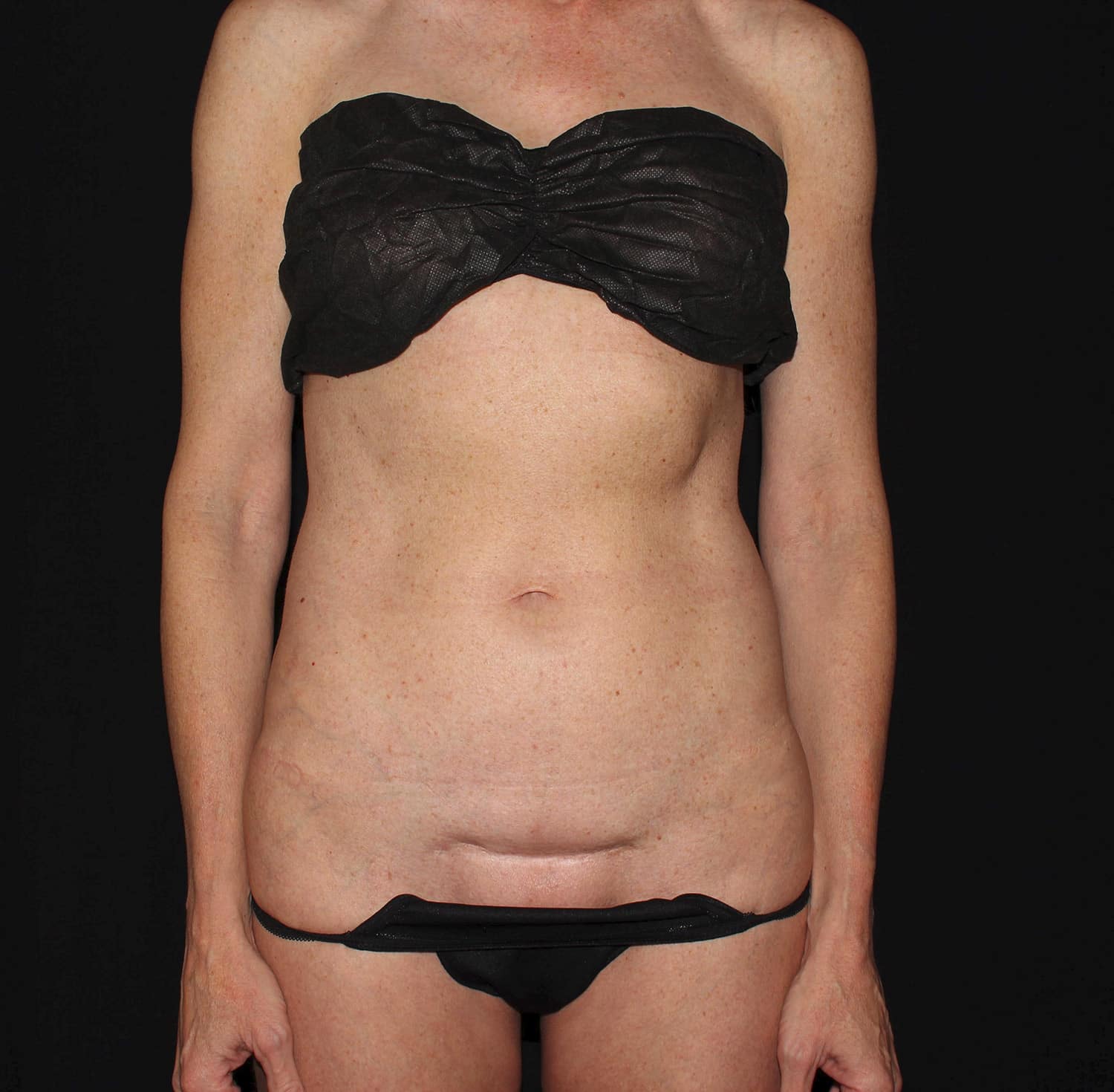 Before Image: Tummy Tuck - front