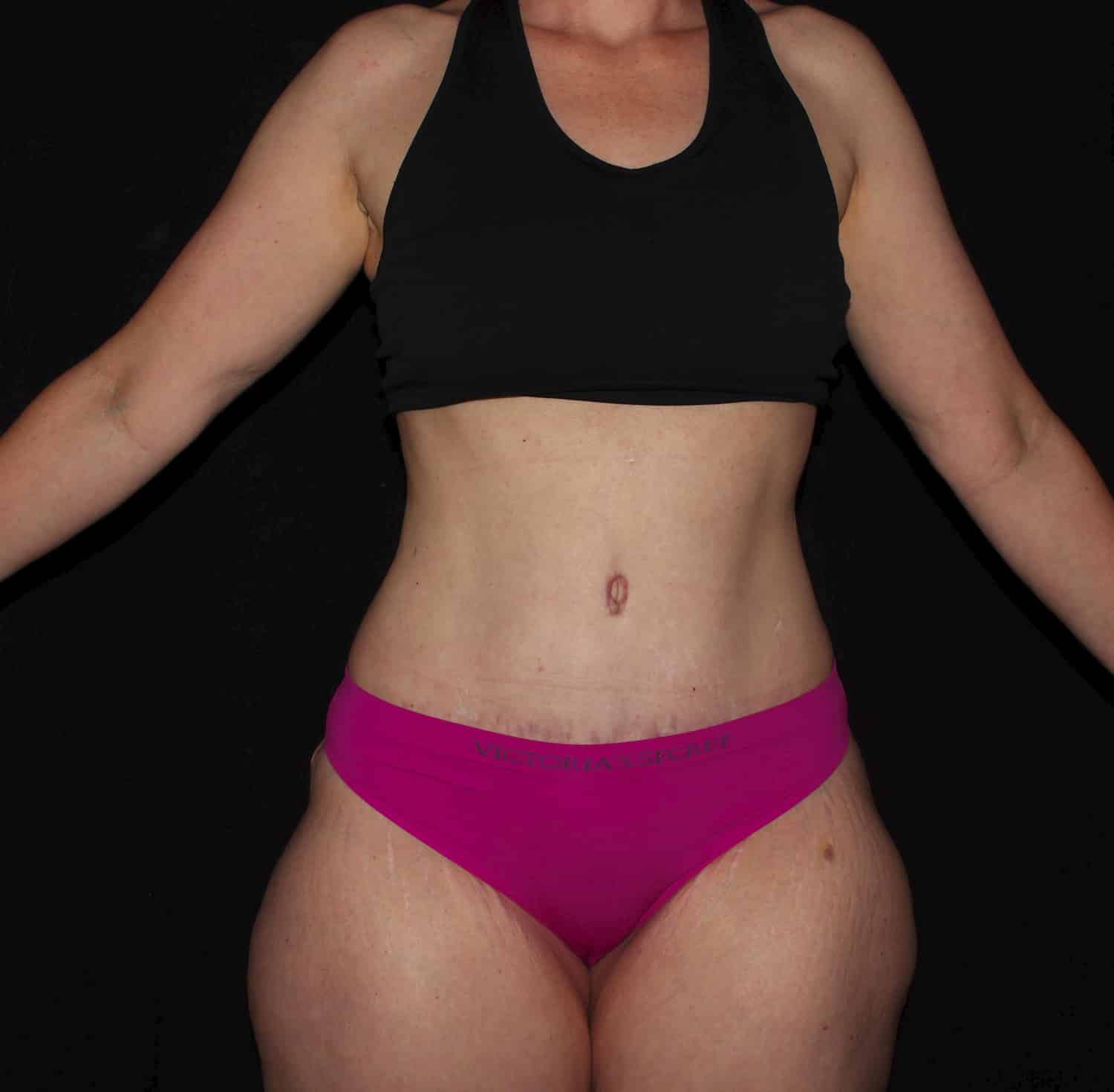 After Image: Tummy Tuck - front