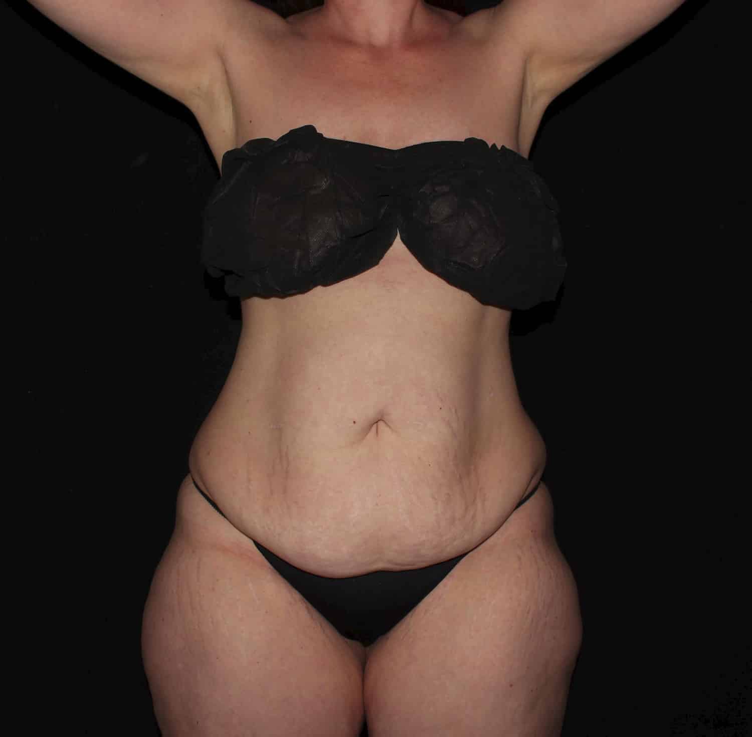 Before Image: Tummy Tuck - front